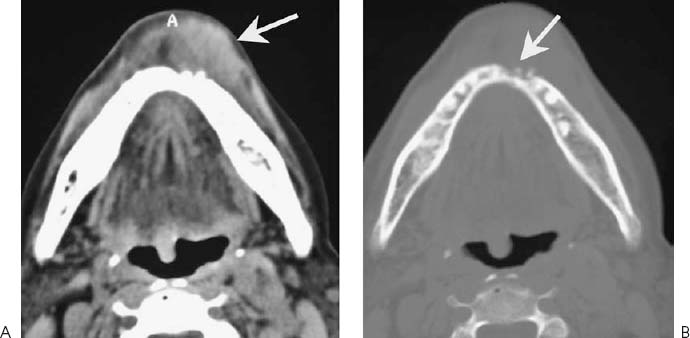 Squamous Cell Carcinoma Radiology 