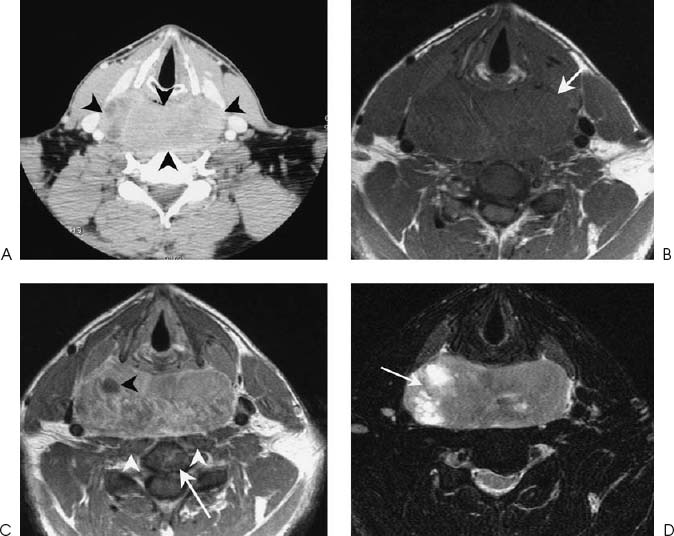 Rhabdomyosarcoma | Radiology Key