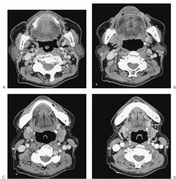 Tonsillar Calcifications Tonsilloliths Radiology Key