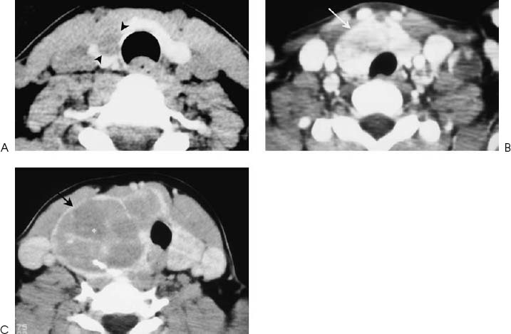 papillary carcinoma of thyroid radiology