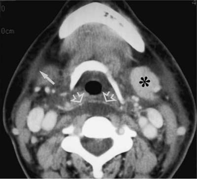 Retropharyngeal Edema Following Radiation Therapy | Radiology Key