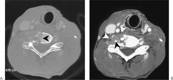 Vertebral Metastases | Radiology Key