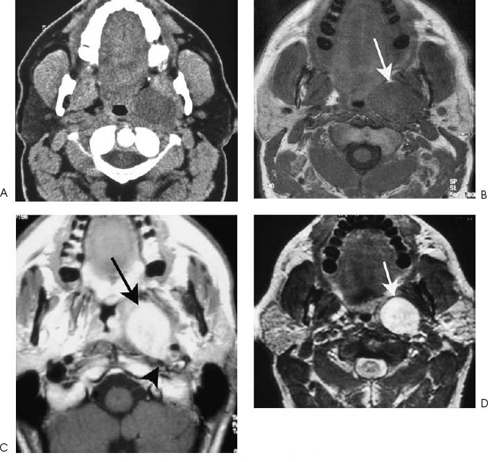 Neurofibroma | Radiology Key