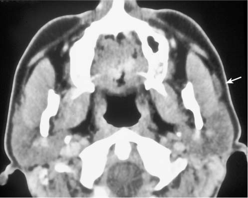 Accessory Salivary Tissue | Radiology Key