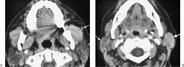 Partoid Duct Calculus | Radiology Key