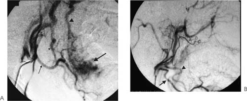 Vascular Malformations Radiology Key