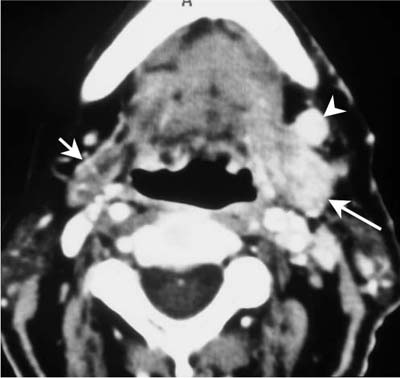 Malignant Minor Salivary Gland Tumors | Radiology Key