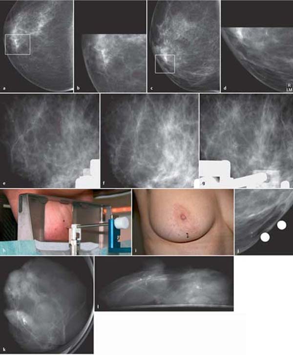 MAMMOGRAPHY  Radiology Key