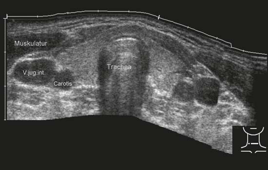 Thyroid Isthmus Ultrasound