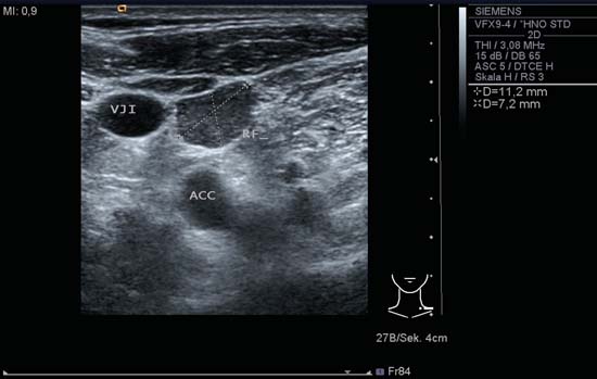 Neck Lymph Nodes | Radiology Key thyroid gland diagram labeled 