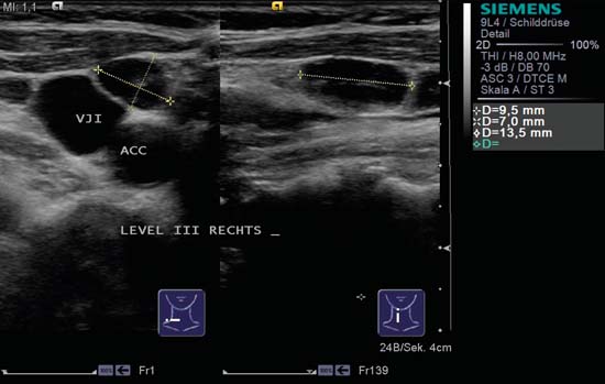 Ultrasound Benign Lymph Nodes Neck