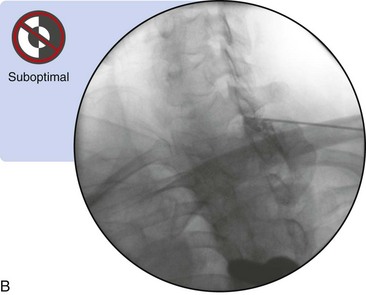 Cervical Interlaminar Epidural Steroid Injection, Paramedian Approach ...