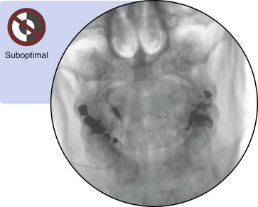 Atlantoaxial Joint Intraarticular Injection | Radiology Key