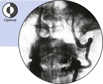 Atlantooccipital Joint Intraarticular Injection | Radiology Key