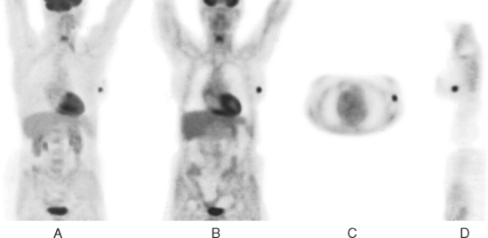 Detection of Breast Cancer: Screening of Asymptomatic Patients