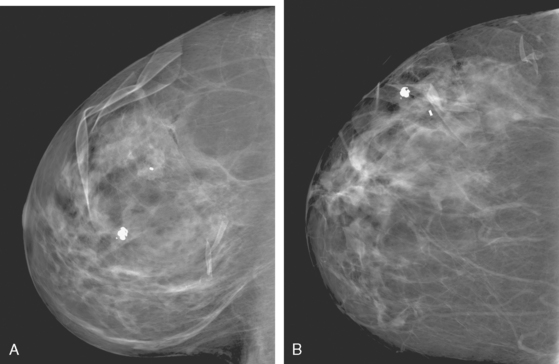 Unusual And Problematic Types Of Breast Cancers Dcis Intracystic Papillary Carcinoma Benign