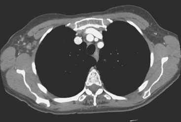 Locally Advanced Breast Cancer Labc And Neoadjuvant Chemotherapy