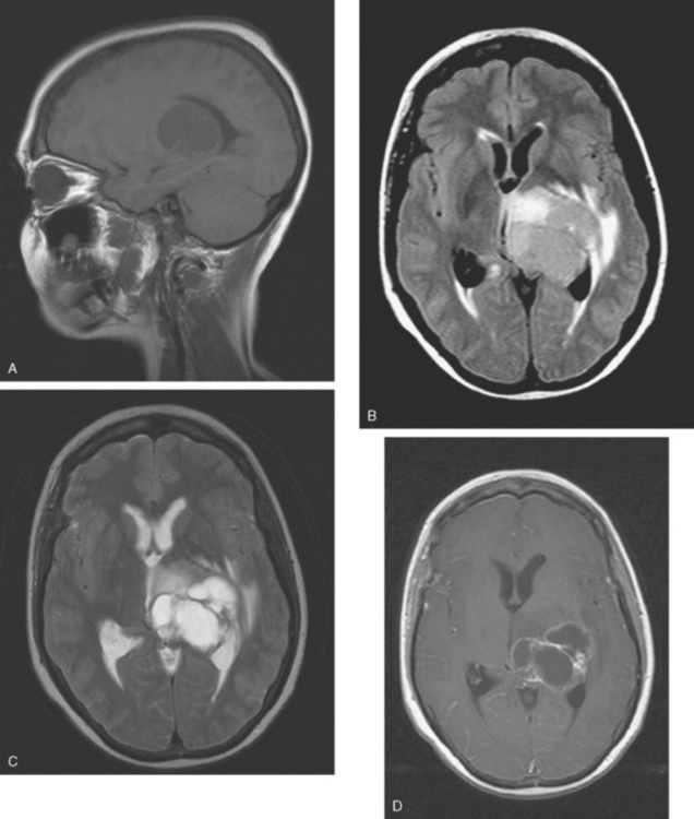 Breast Cancer Metastases to the Neural Axis | Radiology Key