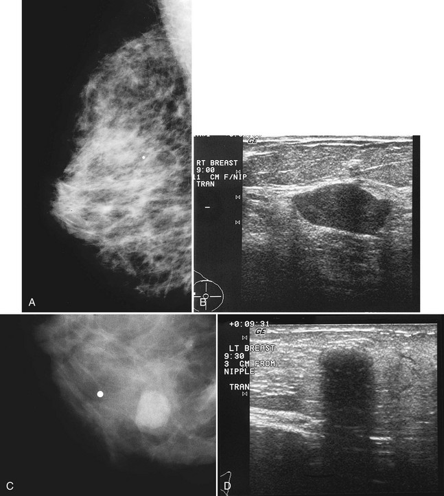 Mammographic And Ultrasound Analysis Of Breast Masses Radiology Key