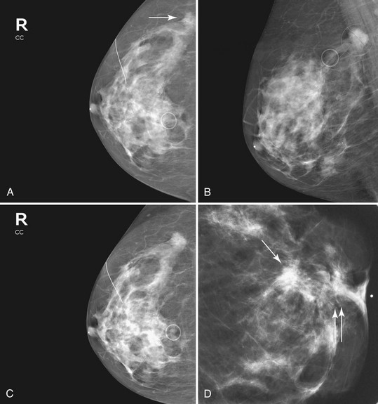 Why the Squeeze During a Mammogram? - Mallinckrodt Institute of