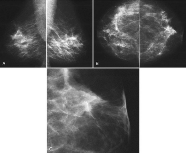 Comparison of the breast mass with the craniocaudal (CC) and