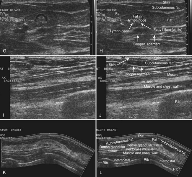 Thoracic wall and breast: normal anatomy