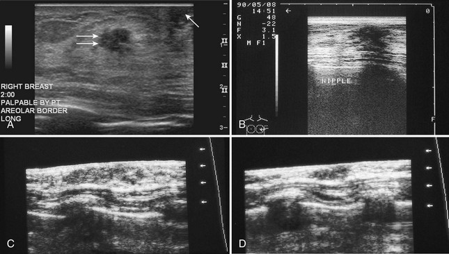 b. Left breast USG showing oval, well-defined, mixed echogenic