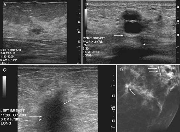 breast-cancer-classification-with-ultrasound-images-based-on-slic