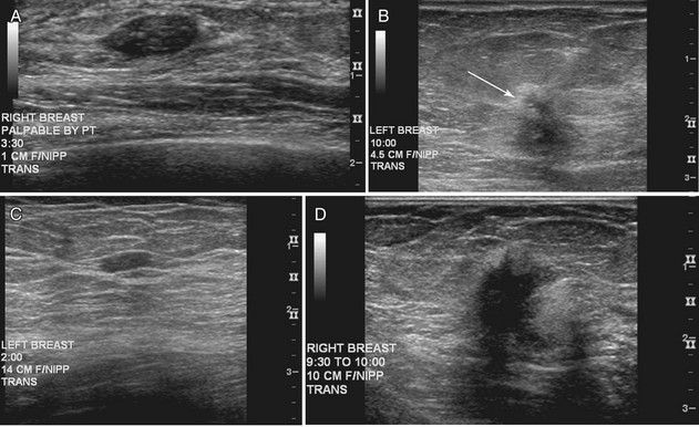 b. Left breast USG showing oval, well-defined, mixed echogenic