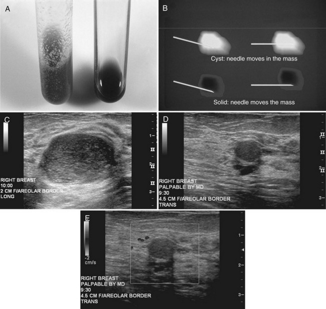 Breast Ultrasound Radiology Key