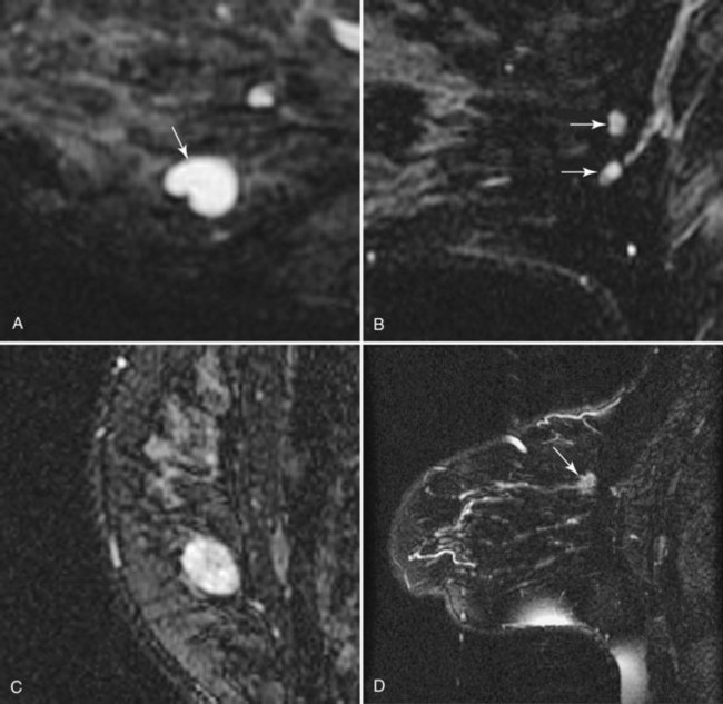 Magnetic Resonance Imaging Of Breast Cancer And Mri Guided Breast