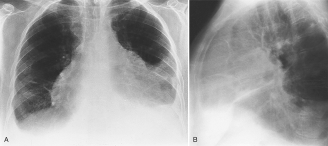 Myocardil Effusion