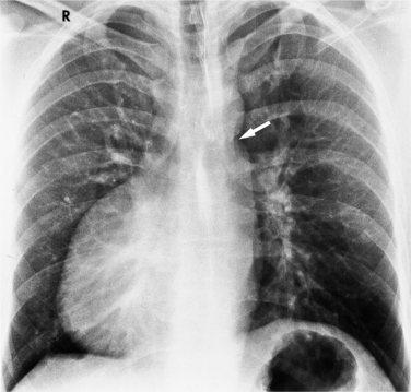 Dextrocardia Situs Solitus Pdf