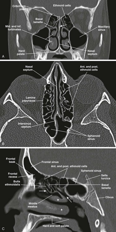 Nose and Sinonasal Cavities | Radiology Key