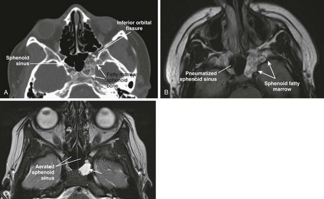 Sphenoid Sinus Aspergilloma Clinically Mimicking As Malignancy A Case Report Egyptian Journal Of Radiology And Nuclear Medicine Full Text