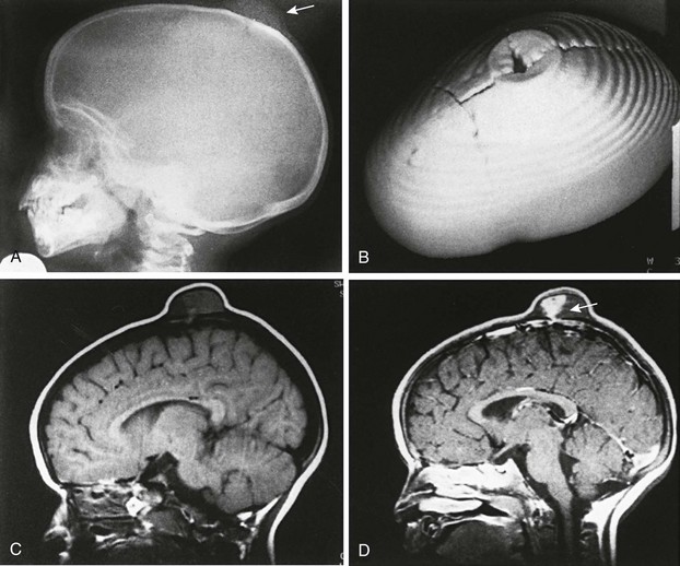 Craniosynostosis, Selected Craniofacial Syndromes, And Other ...