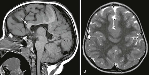 Congenital Brain Malformations | Radiology Key