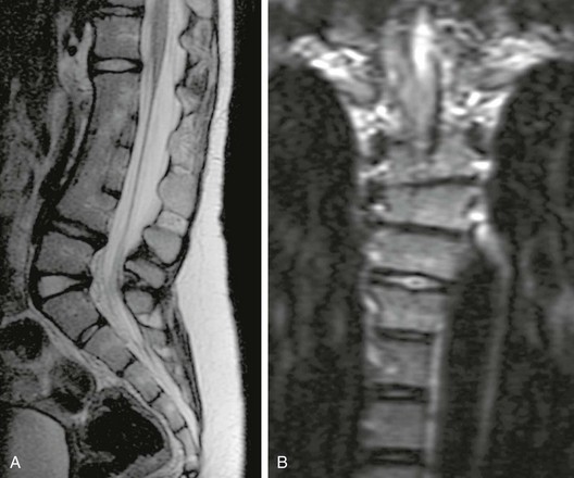 Congenital Abnormalities Of The Spine Radiology Key 6219