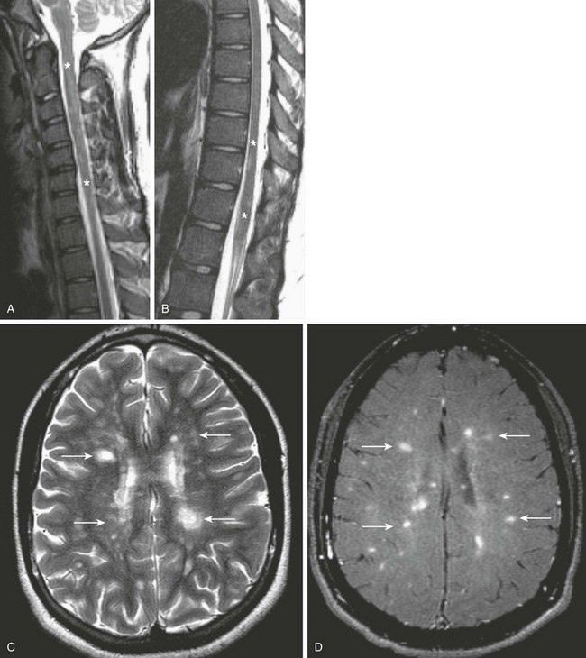 Infections Of The Spine And Spinal Cord Radiology Key 7975