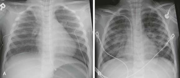 Systemic Conditions with Lung Involvement | Radiology Key