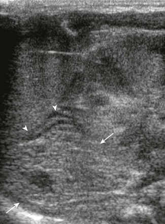 Congenital and Neonatal Conditions | Radiology Key