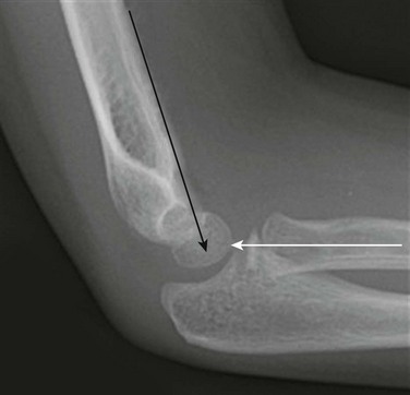 Skeletal Trauma | Radiology Key