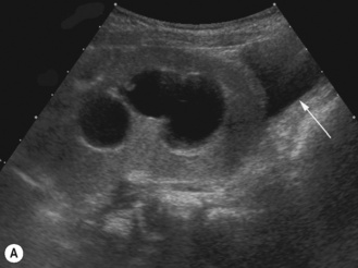 The renal tract | Radiology Key