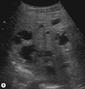 The liver, spleen and pancreas | Radiology Key