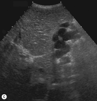 The liver, spleen and pancreas | Radiology Key