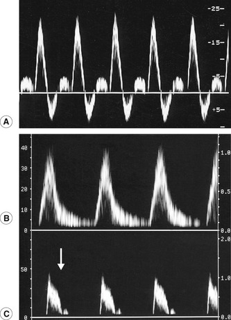 Arterial Waveforms Ultrasound