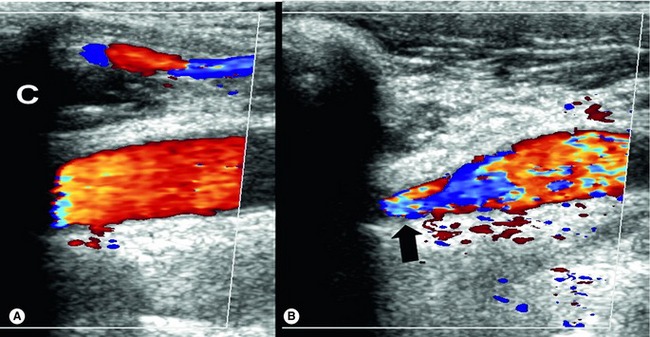 Anatomy Of The Lower Limb Venous System And Assessment Of Venous Insufficiency Radiology Key 9581