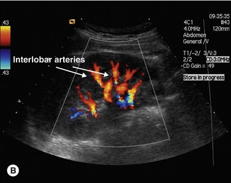 renal artery anatomy ultrasound