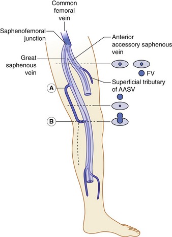 Accessory Saphenous Vein Anatomy