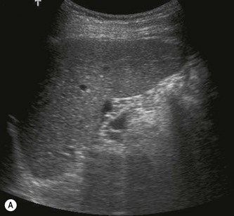 Abnormal Spleen Ultrasound